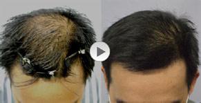 兰州北大皮肤专科医院因为脱发引起的危害主要有哪些