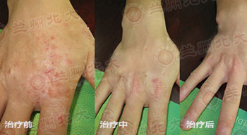 兰州北大皮肤科