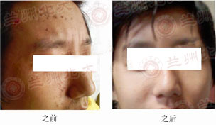 兰州北大皮肤科