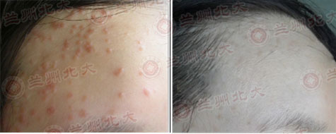 兰州北大皮肤科