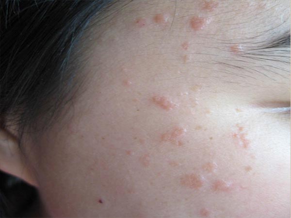 扁平疣造成的危害有什么