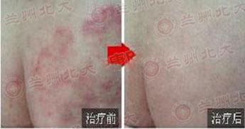 兰州北大皮肤科