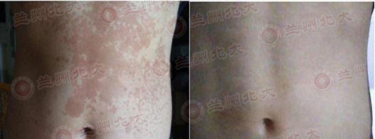 兰州北大皮肤科